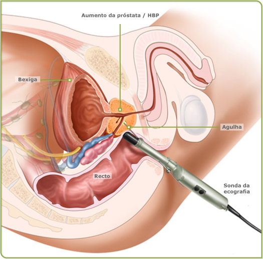 Cancer de prostata histologia, Puncție-Biopsie Mamară cu ac gros eco-ghidată (TRU-CUT)